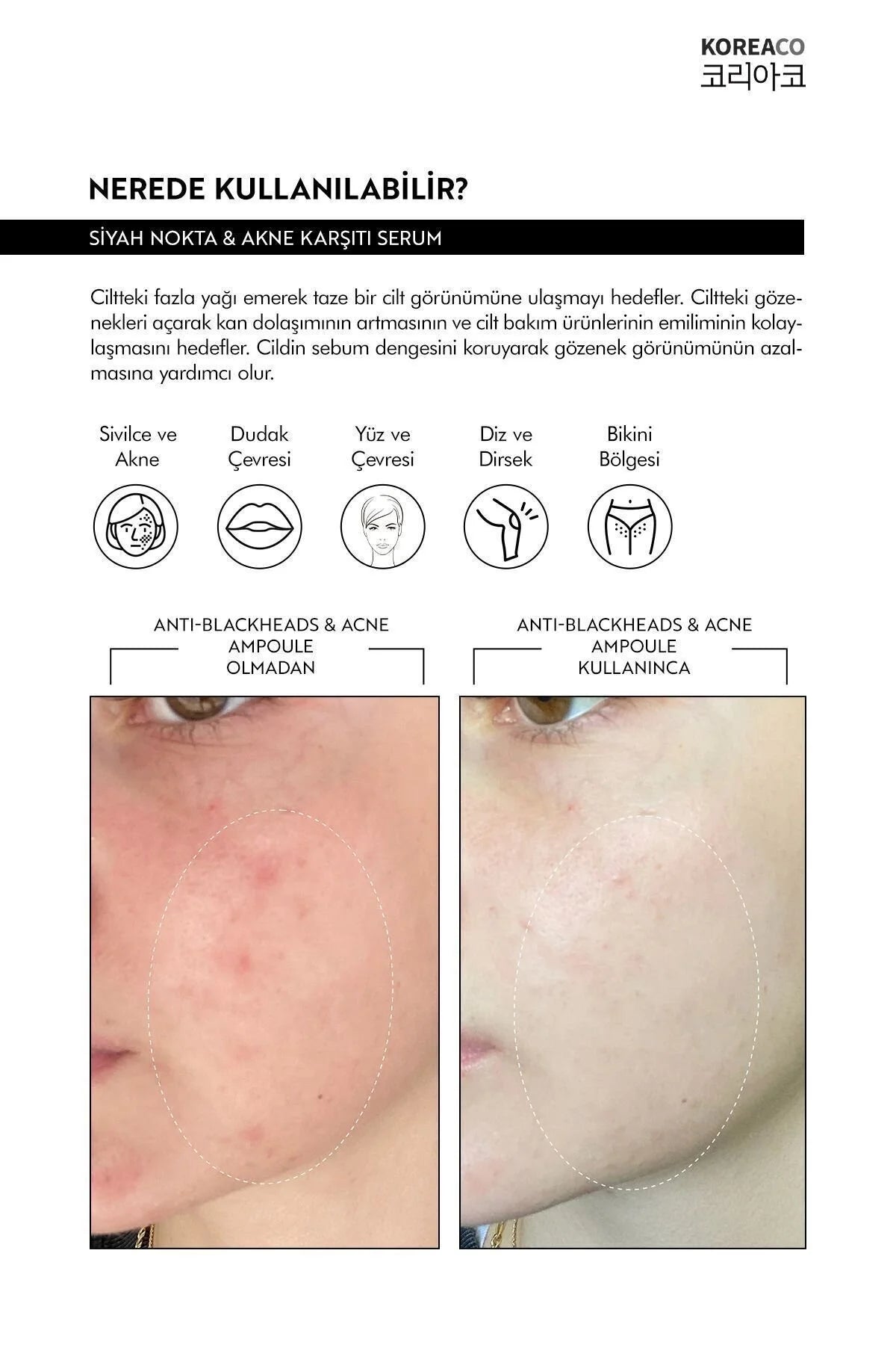 Koreaco - Anti-Blackheads & Acne Ampoule | Anti-mee-eters Acne Ampul | VEGAN | Voor alle huidtypes | 50 (ml.) | Centella | Niacinamide | Makes your skin smooth |