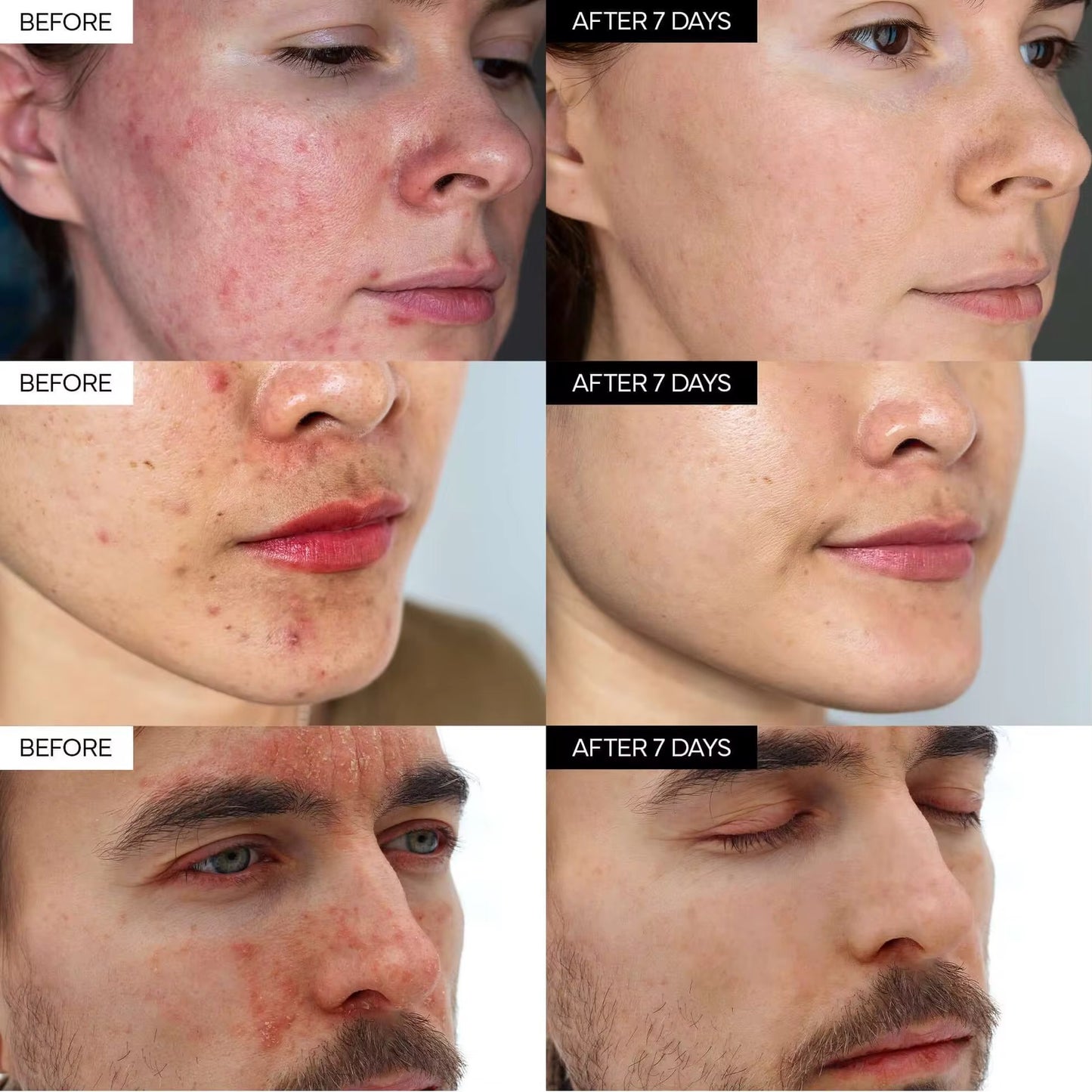Ivoskin Intensive Cica Repair Cream Ultra-Moisturizing Care for Sensitive Skin with Centella Asiatica Madecassoside Panthenol Ceramides Hyaluronic Acid - Herstellende Creme - Ultra-Hydraterende verzorging voor gevoelige huid - Diepe hydratatie - 50gr